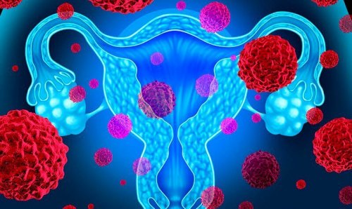 Le cancer de l'endomètre : 5 aspects à prendre en compte