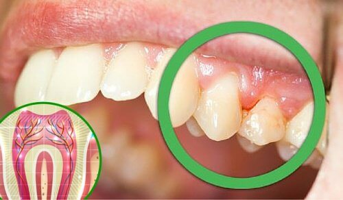 6 raisons pour lesquelles vos dents vous font mal
