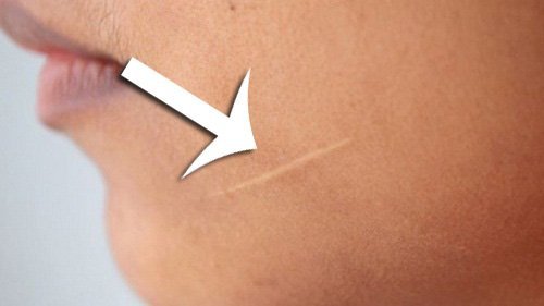 Comment éliminer les cicatrices de la peau ?