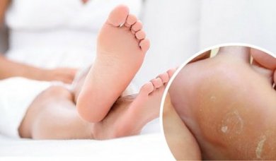 Éliminez les cors aux pieds avec ce remède efficace