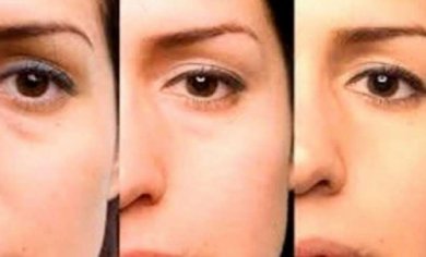 Conseils pour vous défaire des poches sous les yeux