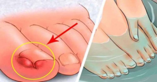 6 remèdes naturels pour traiter les ongles infectés