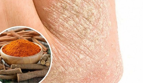 7 astuces pour faire face au psoriasis de manière naturelle