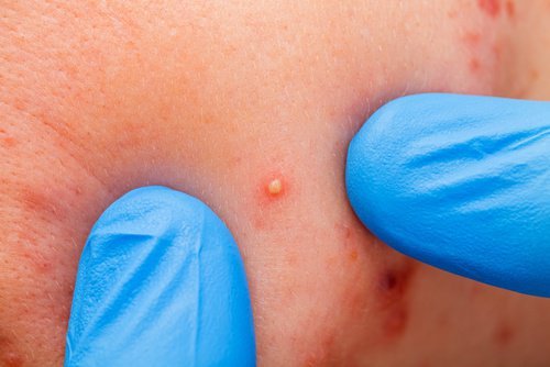 Acne-500x334