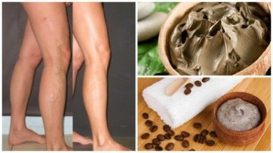 5 solutions naturelles pour combattre les varices