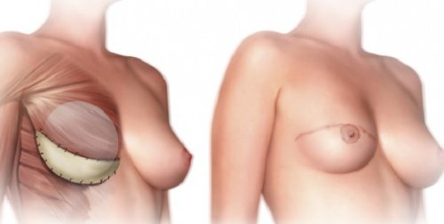Que savoir avant de faire une mastectomie ?