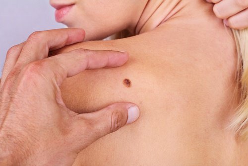 7 choses méconnues sur le cancer de la peau