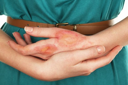 Le cancer de la peau peut être dû à une infection
