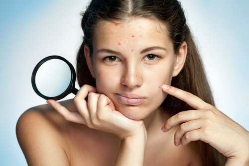 Le stress a un lien avec le développement de l'acné.