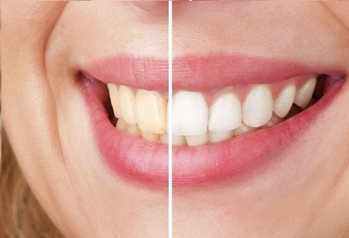 Sourire dents blanches et jaunes 