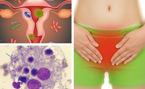 6 conseils pour soulager les mycoses vaginales