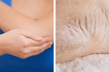 Apprenez à adoucir vos coudes et vos talons avec des produits naturels