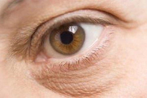 Remèdes pour les poches sous les yeux