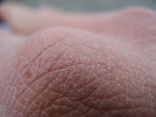 peau-seche-500x375