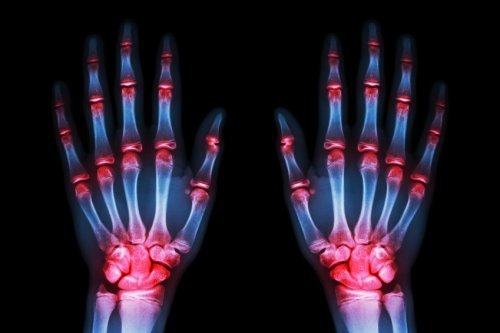 Une étude récente affirme que d'ici 5 à 10 ans, un traitement permettra de "freiner" l'arthrose
