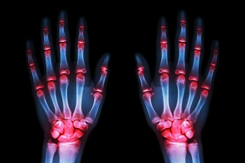 Une étude récente affirme que d’ici 5 à 10 ans, un traitement permettra de “freiner” l’arthrose