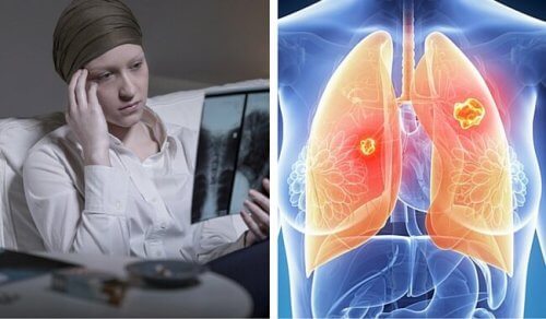Le cancer du poumon est beaucoup plus mortel chez les femmes