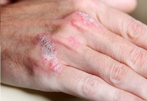 5 choses à connaître sur les maladies auto-immunes