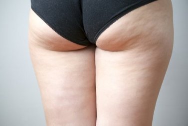 Pourquoi ne parvenez-vous pas à éliminer votre cellulite ?