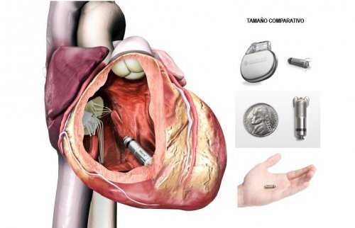 pacemaker micra dans le coeur