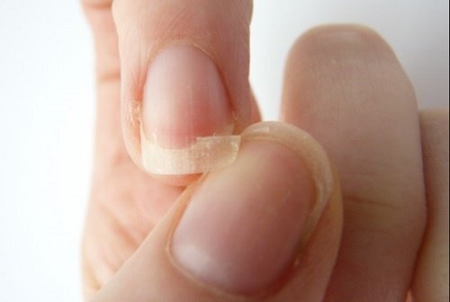 9 causes des ongles cassants