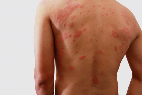 prendre une douche : attention aux problèmes de peau