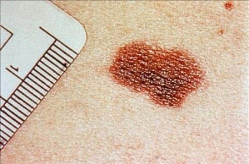 8 symptômes alarmants chez les personnes âgées