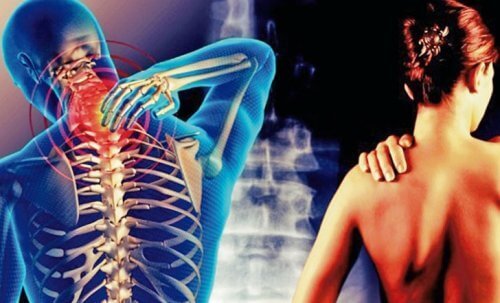 La cervicobrachialgie : cette douleur qui part du cou jusqu'au bras