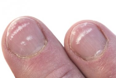 Pourquoi des marques blanches apparaissent sur les ongles ?
