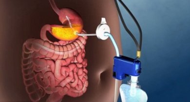 Découvrez la nouvelle technique pour traiter l'obésité grave sans chirurgie