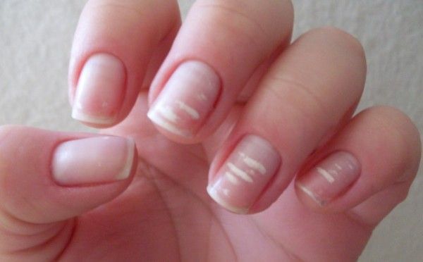 Les marques blanches sur les ongles.