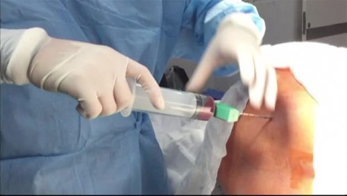 Ponction de moelle osseuse.