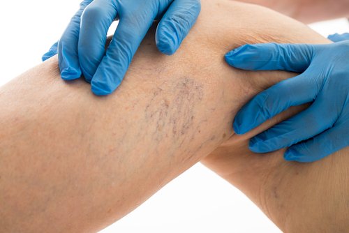 Comment soulager les douleurs causées par les varices