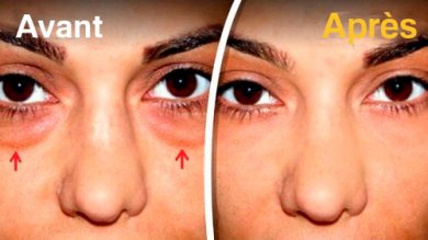 Comment atténuer les poches sous les yeux