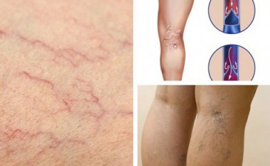 6 changements pour profiter d'une meilleure santé vasculaire dans les jambes