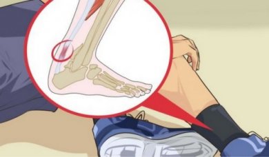 5 remèdes contre la tendinite du tendon d'Achille