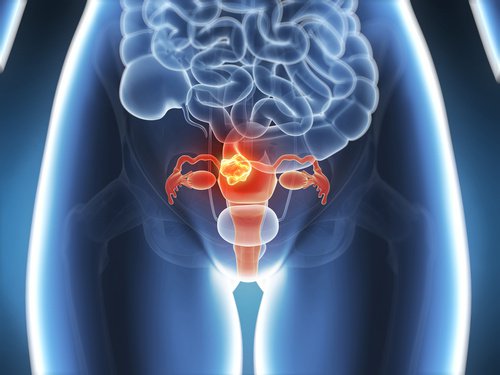 6 symptômes du cancer du col de l’utérus à connaître