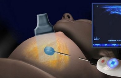 La cryoablation : nouveau traitement du cancer du sein