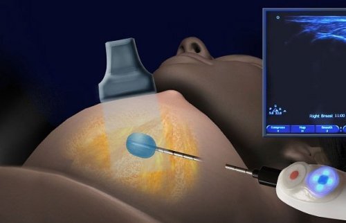 cryoablation-2-500x322