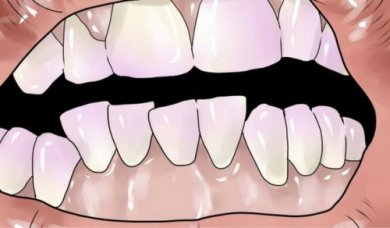 Comment éliminer naturellement le tartre des dents ?