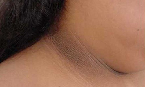4 manières d'atténuer la peau noircie du cou