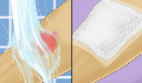 Premiers soins en cas de brûlures à l'eau chaude