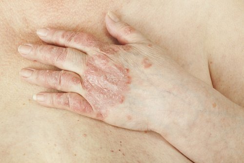 La démangeaison et leczéma sur les jambes
