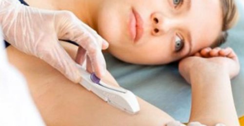 La pose d'implants contraceptifs pour éviter de tomber enceinte.