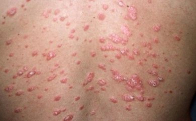 Les différents types de psoriasis