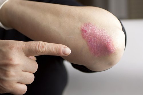 Psoriasis sur le coude