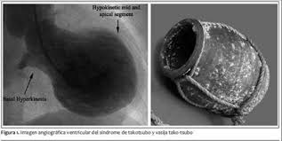 Symptômes du cœur brisé.