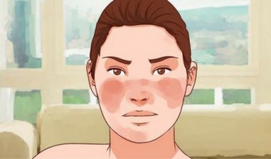 7 remèdes pour contrôler le lupus