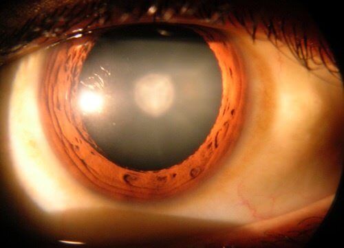 8 choses à savoir sur la cataracte
