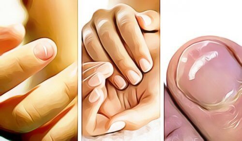 5 signes de mauvaise santé visibles sur les ongles